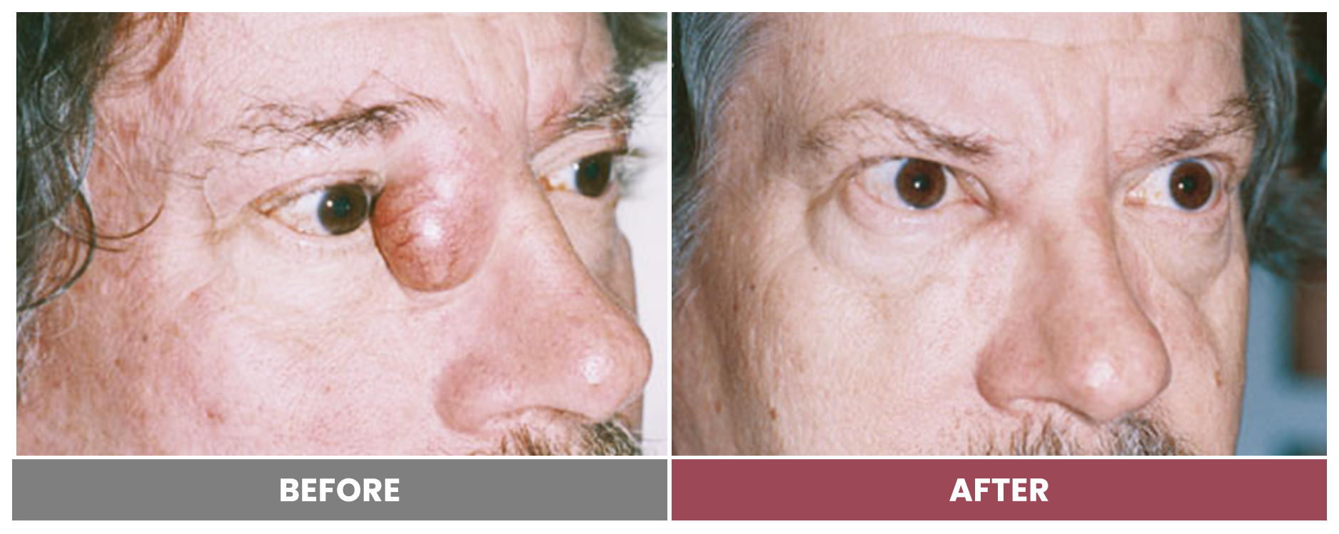 TUMOR REMOVAL AND RECONSTRUCTION - Case 2